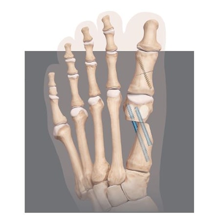 Minimally Invasive Bunion Surgery in Derby, Connecticut